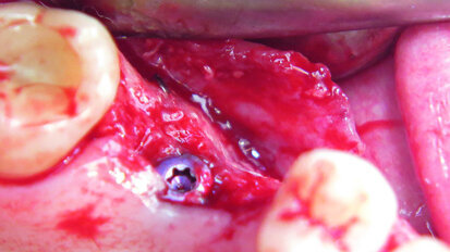 Guided bone regeneration in smokers - Use of synthetic bone blocks