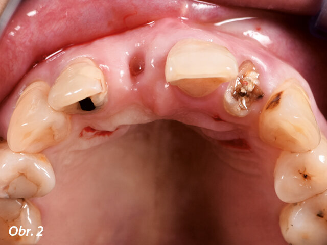 Obr. 2: Výchozí stav předních zubů z okluzního pohledu