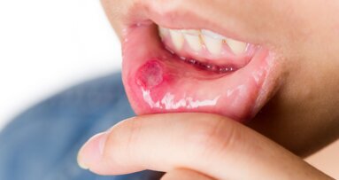 New treatment for aphthous ulcers to undergo a clinical trial in Sweden