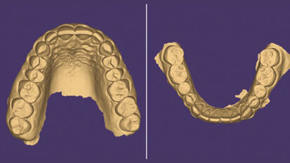 Workflow digitale  in gnatologia. Caso clinico