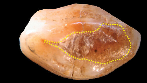Stone-age dental filling identified