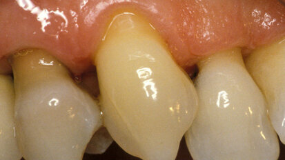 L’ipersensibilità dentinale un problema fastidioso