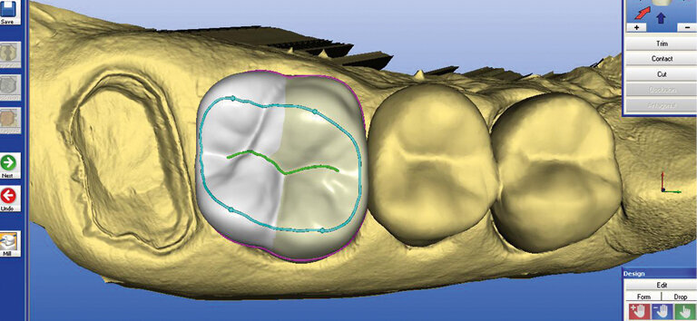 Fig. 6: The CEREC software V3.8 did not yet allow entire quadrants to be reconstructed in a single step.