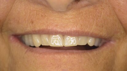 Implantología con anclaje extramaxilar