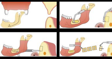 Piezocirugía  (10). Efectividad del piezoeléctrico en la terapia ósea regenerativa