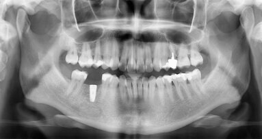 Cas clinique de chirurgie guidée : « C’est la prothèse qui guide l’implant et non le contraire. »