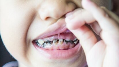 Produženo dojenje povećava rizik za razvoj karijesa