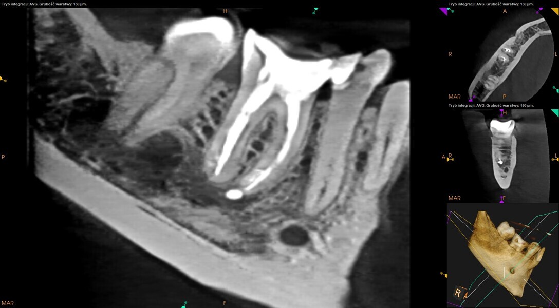 Fig. 25: CBCT scan at the 12-month follow-up.