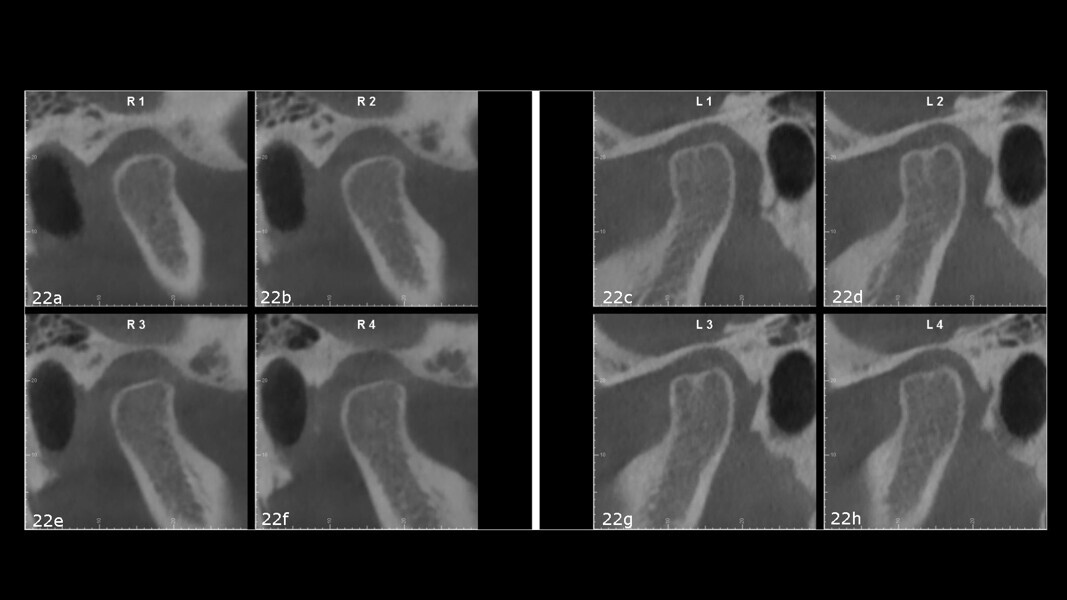 Figs. 22a–h: Temporomandibular joint sagittal images from the CBCT scan.