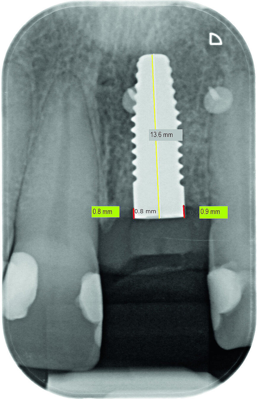 Fig. 13a: Bone resorption was detected after six months and bone gain after 12 months. The yellow line represents the actual implant length (13.6mm). The red lines indicate the mesial and distal distances from the top of the implant to the first bone contact.