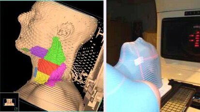 Un nouveau système de radiothérapie diminue significativement l'irradiation dans les zones saines
