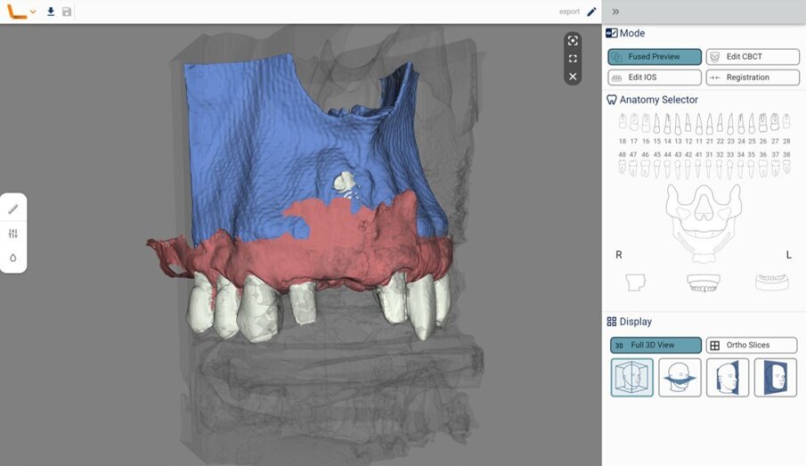 Fig. 4_Intelligenza Artificiale (Virtual Patient Creator, RELU): segmentazione CBCT e allineamento automatico CBCT-IOS.
