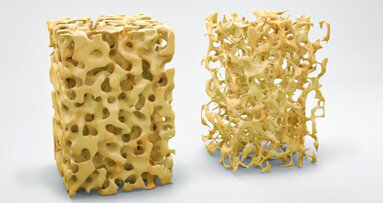 Osteoporosi: gli impianti in magnesio biodegradabili potrebbero promuovere la formazione dell’osso