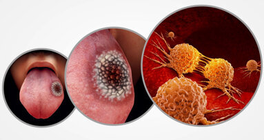 “20 años de Avances en Cáncer Oral”