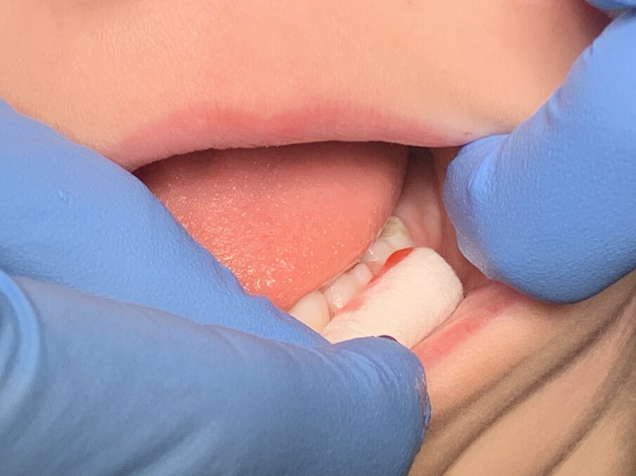 Afbeelding 1. Oppervlakte-anesthesie met benzocaïnezalf op de papil.