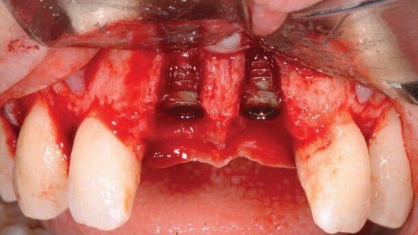 Odbudowa siekaczy centralnych: implantacja, przeszczep kości i tkanek miękkich