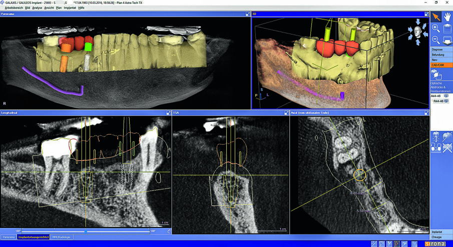Matching of Orthophos SL 3D data with the prosthetic proposal in Galileos Implant.