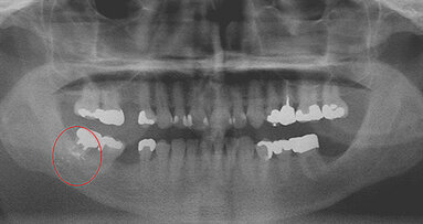 Foreign bodies discovered during routine dental treatment