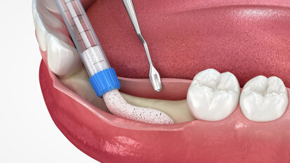 Webinar to focus on peri-implant tissue augmentation and maintenance