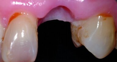 Préservation de la crête alvéolaire après extraction