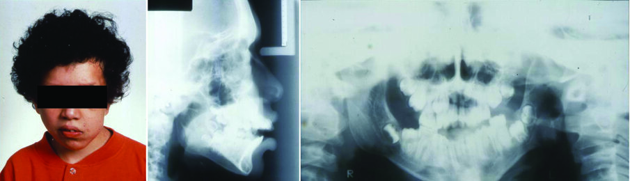Figure 1. Facial photograph of an 11-year-old girl with neurofibromatosis (a). The lesion is also apparent in lateral cephalometric (b) and panoramic (c) radiographs.