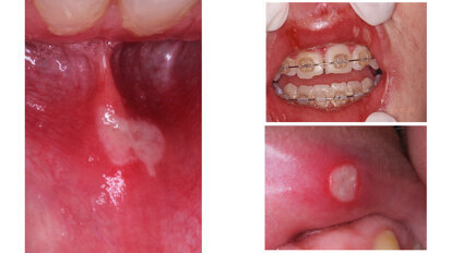 Aftas bucales. ¿Hay algo nuevo? Aftas bucales. ¿Hay algo nuevo?