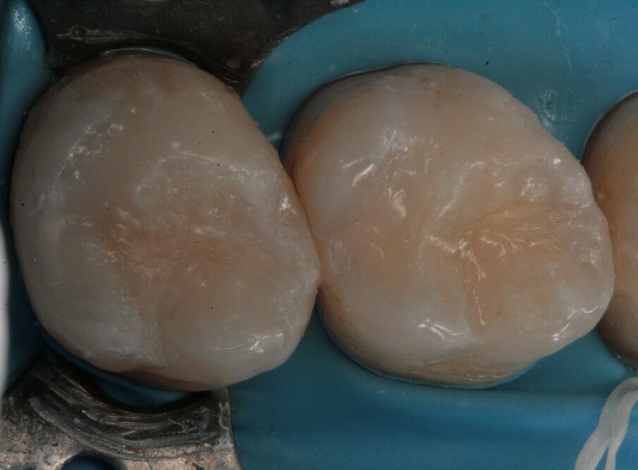 Figg. 17, 18_Restauri delle cavità.