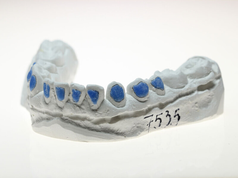 Figura 15. Modelo de yeso piedra con resina en las caras vestibulares.