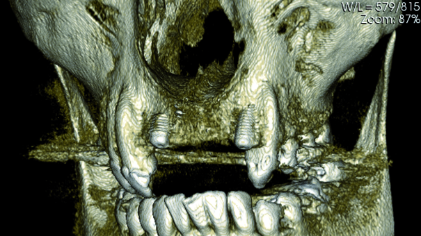 One week diary with our X-Mind Trium 3D CBCT in practice