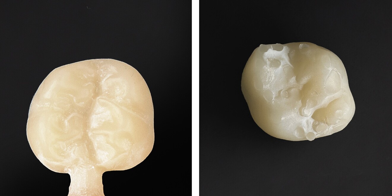 Milled crown (left) and 3D-printed crown. Milling leaves a small sprue in an inconspicuous position on the side of the restoration that can easily be removed by hand. In contrast, 3D printing requires thin supporting structures, which may be placed on functional or visible surfaces depending on the orientation and support strategy, making removal and finishing more difficult. Residual printing resin can be seen as a white film.