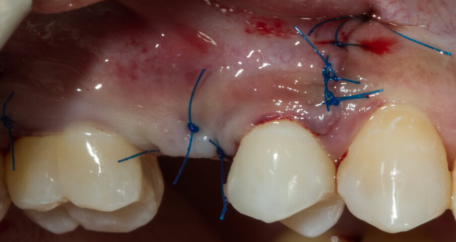 Fig. 13 - Sutura del lembo.
