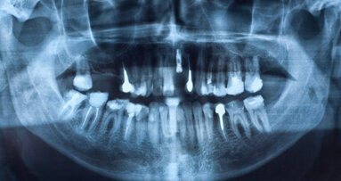 Menopause: Bisphosphonate begünstigen Verlust von Implantaten