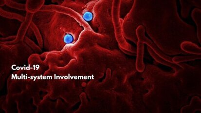 COVID-19: Beyond a respiratory illness. A Multi-system Inflammatory Syndrome (MIS)- Amisha Parekh