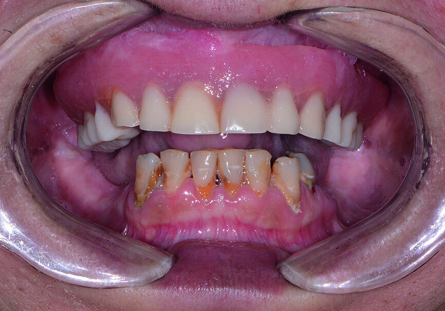 Fig. 1: Pre-op retracted view.