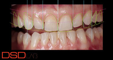 Digitální vs. analogový pracovní postup u keramických fazet v horní čelisti