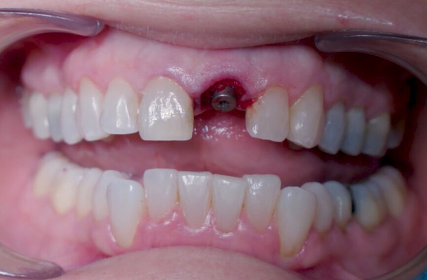 Fig. 18: Biomaterial application finalised.