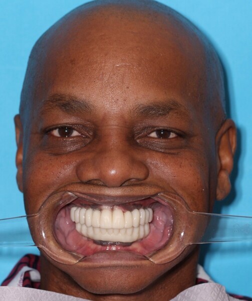 Fig. 25: Full-face retracted view of the try-in Flexcera Smile final prostheses duplicates, confirming improved aesthetics and function.