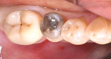 Amalgam replacement: When and why are hybrid ceramics a great option?