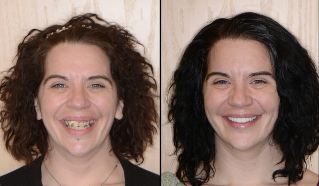 Figs. 20a & b: Pre-op (a) and post-op facial view (b).