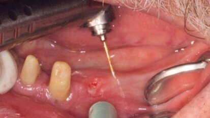 Innowacyjne sposoby usuwania tkanek przy użyciu lasera Er:YAG