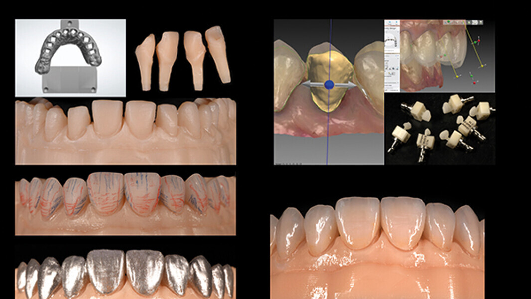 Fig. 14. Flujo de trabajo digital (modelo impreso en 3-D, carillas CAD/CAM, ajustes, tinción/ glaseado).