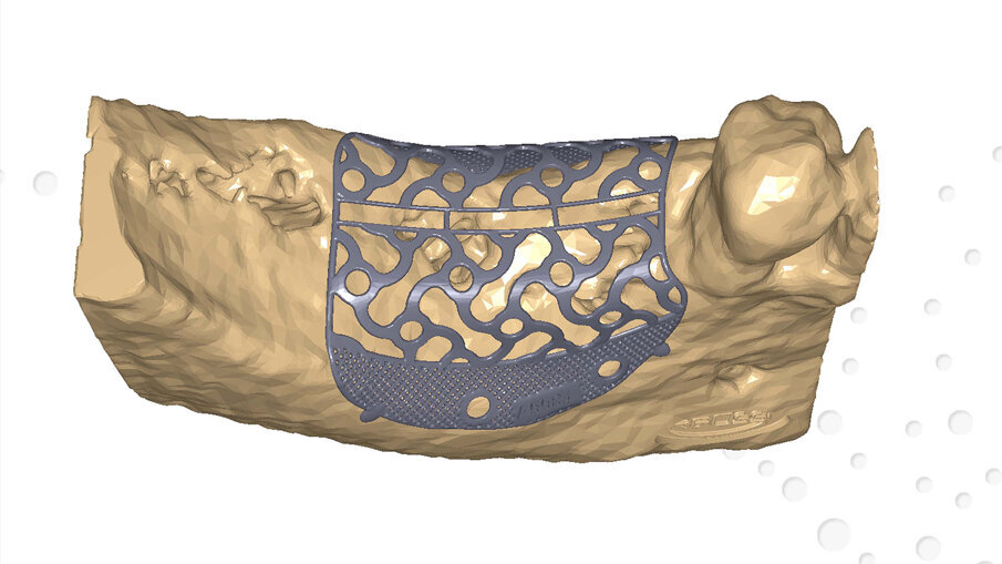 Figg. 2a, 2b_Modello digitale con il progetto definitivo della griglia in titanio customizzata Yxoss CBR protect.