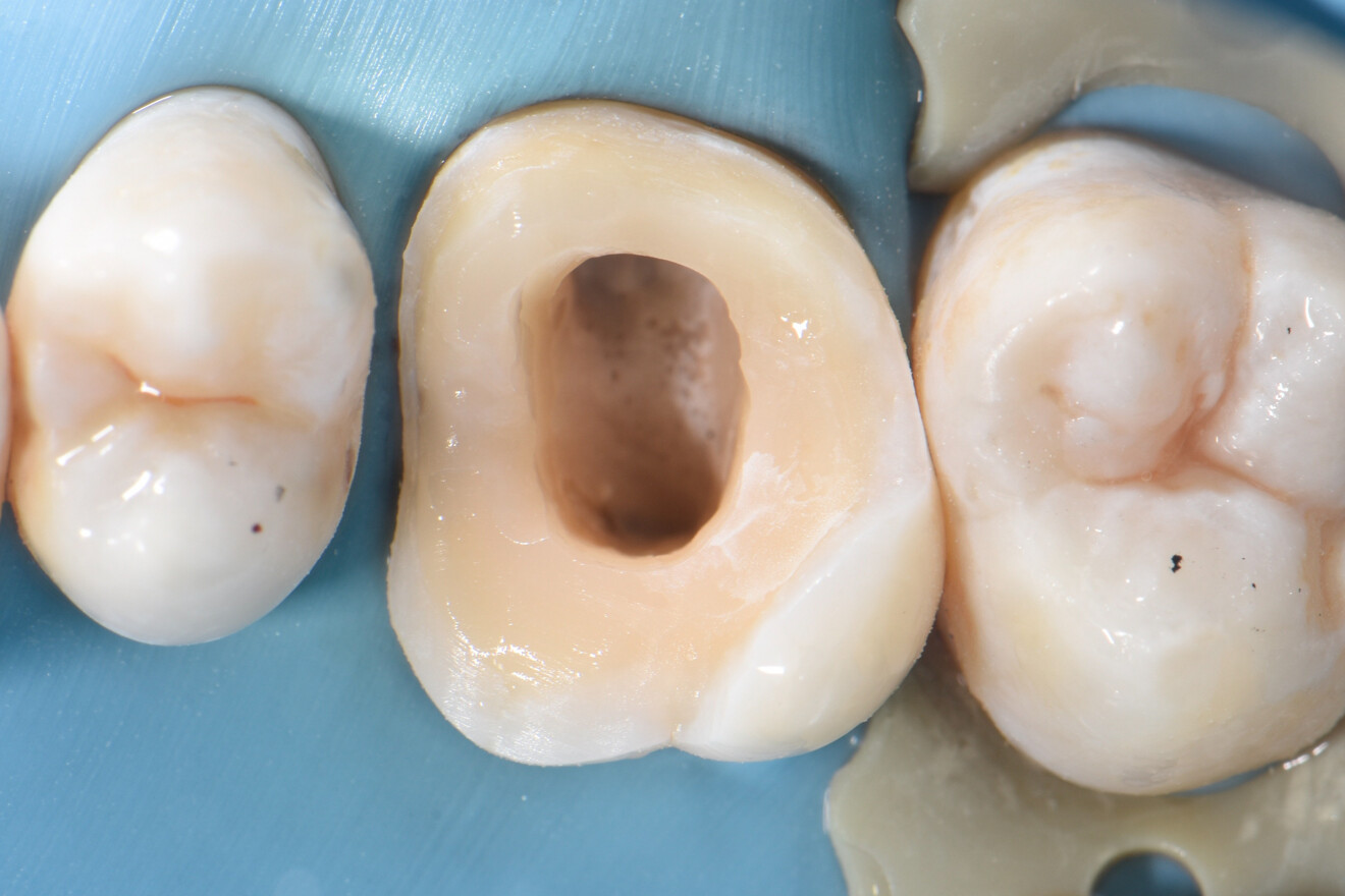 Fig. 12: Finishing the onlay preparation.