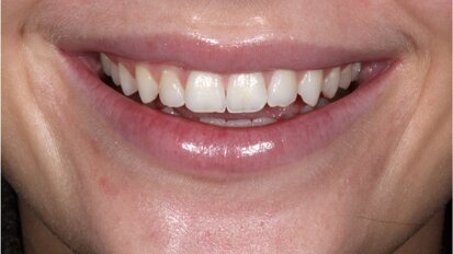 Verbeter je glimlach met composiet