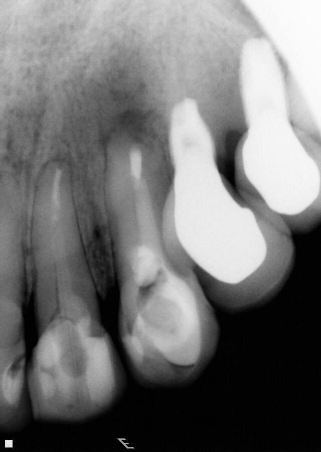 Fig. 6: Periapical radiographic follow-up after 30 and 90 days, showing a fast regression of the periapical lesion and a bone repair.