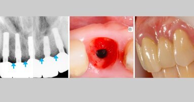 Resultados a largo plazo de una implantología simple
