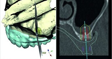 Digital possibilities for making implant prosthetics
