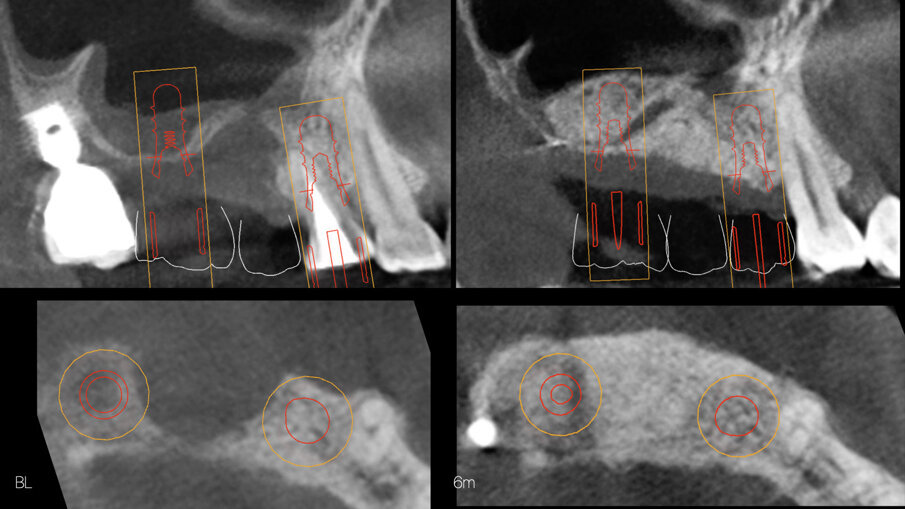 ; Fig. 10 - CBCT al baseline e a 6 mesi - visione assiale e para-sagittale.