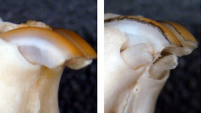 Kaybedilen Dişler Yeniden Çıkabilir mi?