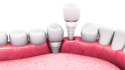 Nanokeramik aus der Kugelmühle für stabilere Zahnimplantate Nanokeramik aus der Kugelmühle für stabilere Zahnimplantate